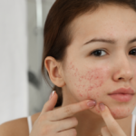 Advanced Acne Spot Treatment Creams Designed For Visible Blemish Reduction